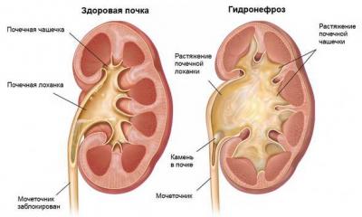 Hydronephrosis in pregnant women Hydronephrosis kidney symptoms treatment during pregnancy